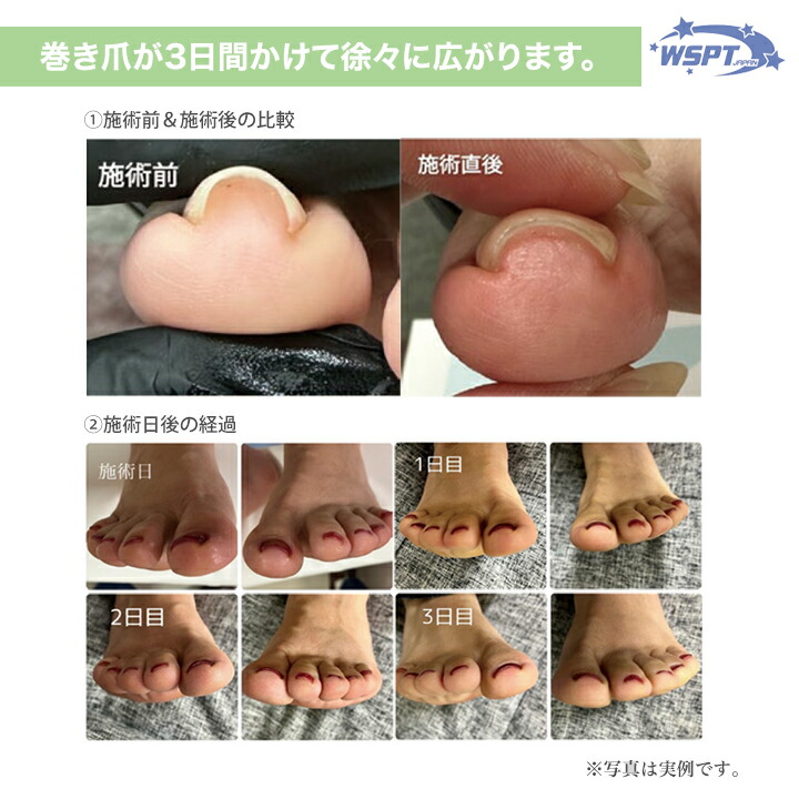 楽天市場】巻き爪ケア フラットケアジェル 3本セット : テンダンス