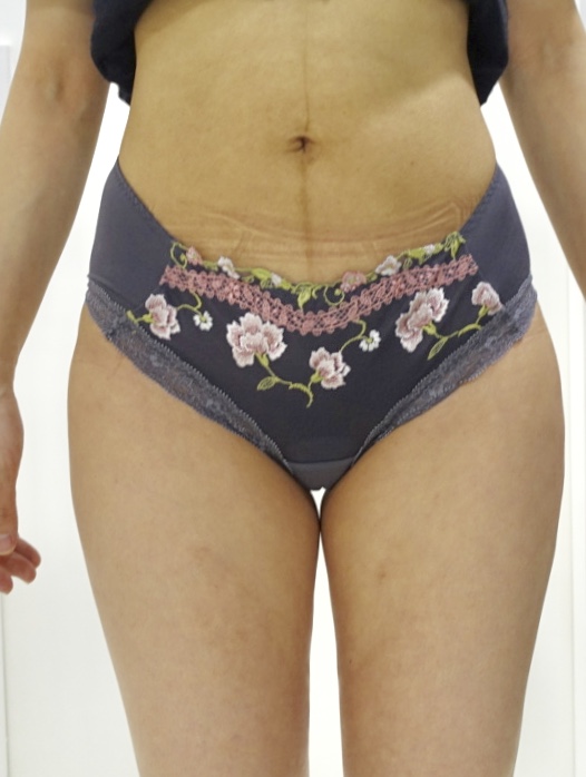 ほぼ未使用】最新ライポソニックススタンプ痩身80J 2026年最新】ライポ