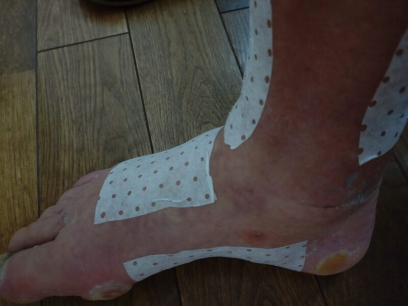 構造医学・薄膜型境界層メッシュ | カッコイイおじい！を目指すラン